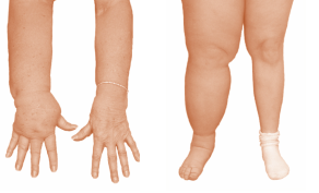 What is Lymphoedema?